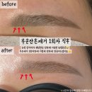 1회만 받고 2회 예약 취소했어요! 부평 눈썹문신제거, 뷰티남달리 내돈내산 솔직후기