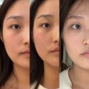 합정 마포 포미 에스테틱 페이스 컨투어링 윤곽관리 리프팅 후기