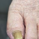 발이야기 | 내성발톱 [탱스네일&amp;오로지푸스 무좀 내성발톱 발각질 맞춤깔창] 후기 남양주 마석 화도 발관리 이야기