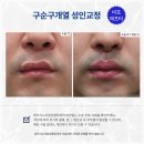 최우식노즈립성형외과의원 | 구순구개열 성인 교정 후기 흉터제거 비대칭 인중골 복원치료