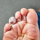 티눈 냉동 치료로 보는 병원 치료 과정과 제거 방법 이미지
