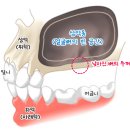 창원W더블유치과의원 | [창원 의창구 치과] 위턱 어금니 임플란트, 뼈가 부족하다면? 상악동거상술로 해결하세요!