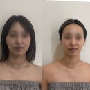 유에스메디팜(유) | 포아유에스테틱에서 윤곽 관리 받고 얼굴 작아진 후기