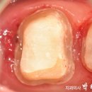 엔도코어 이미지