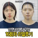 보람한의원 | 안면비대칭 교정: 둔촌역 한의원 16회차 리얼 후기