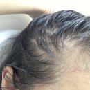 탈모야안녕 | 탈모토닉 헤어라인 탈모 케어 후기