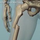 Femoral neck & shaft fracture 이미지