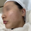 아비 | 영등포 피부과 추천 피지선을 직접 파괴하는 아비클리어 내돈내산 후기 효과 통증 비용