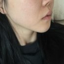 볼륨 | 귀족해도 소용없는 팔자 대구쥬베룩볼륨 후기 (5cc 전/후 사진있음)