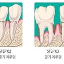 풍치 원인 예방 치근활택술 치주소파술 치주판막술 치석제거 이미지