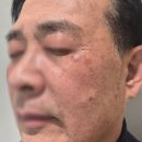 루카스병원 | 서초동 피부과 : 아빠 피부 레이저 5회차 ♩ 톤이 진짜 밝아졌어요 (루카스토닝+제네시스)