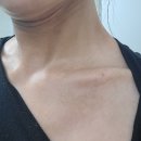 [★내돈내산 제이제이 피부과의원 방문후기★] 아토피피부염&amp;습진