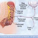 Kidney failure, chronic 이미지