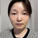 고센의원 | 인천성형외과 팔자주름 입가주름 실리프팅 4개월차 후기