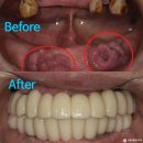 현풍행복을심는치과의원 | 잇몸종양 불편한틀니로 잇몸이 종양처럼 부풀었다면? 최소 개수 전체 임플란트로 해결