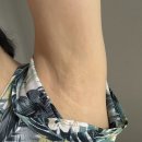 J# - 칠곡군 | 강남 신사역 와이드파워 미라드라이 프레쉬 겨땀제거시술 한달차 극J 내돈내산 후기