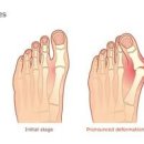 갑자기 엄지발가락 통증 원인 자세히 알아봐요 이미지