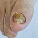 진영메디칼 | 김해 발톱무좀 100년 노하우의 독일 풋케어로 해결