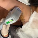 3 | 겨땀냄새제거 미라드라이 3주차 후기 (주의사항, 부작용)