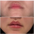 어린공주성형외과의원 | 어린공주의원에서맞은 입술필러 후기(최근사진도 있음)
