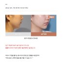 살빼야 | 얼굴지방흡입후기 불독살은 '이렇게' 빼야 합니다
