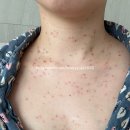 자연닮은한의원 | (수정됨 비추 후기) 편평사마귀와 쥐젖 온몸 무제한 제거 후기_365이채한의원 부산대연점