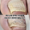 청호초등학교 | 목포 상동 문제성 내성발톱 케어는 바로 이곳! 풋풋한리쌤입니다.