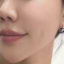 강남 리쥬란힐러 4cc 비수면 풀페이스 후기 (손주사 효과, 부작용 총정리)