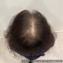 홍산시장 | 전주두피문신수강 SMP 가격 비용 효과 후기망하기 싫으면 꼭 보세요