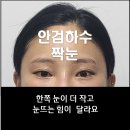 아이본한의원 | 안검하수, 짝눈이 고민이세요? 아이본리프팅으로 해결하세요! #안검하수 #짝눈 #아이본리프팅
