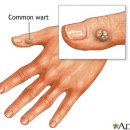 [입이트이는영어] 5월 29일 수요일 사마귀(Wart) 이미지
