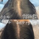오봉오거리 교통섬 | 헤드샷스칼프 엘] 성남 두피채움 SMP_정수리 가르마 채우기 대작전 1차 2차 후기_체험단에서 내돈내산까지