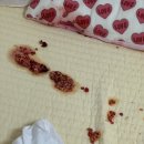 초당실비 | 22개월 아기 수족구 3박4일 입원 후기,비용 실비청구 : 대전탄방엠블병원