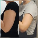람필라테스 | 11주차 팔뚝 람스 흉터 후기와 팔뚝 지흡 비용 솔직 공개! 팔뚝 람스 당일 후기까지