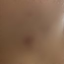 천수온누리약국 | 여드름 흉터에 동아제약 노스카나