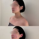 수원-0897 | [수원] 치유가인 : 수원윤곽관리 치유가인 후기, 무너진 얼굴라인과 어깨 승모라인까지 달라진 변화