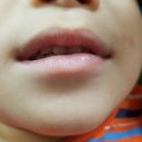 김형주한의원 | 삼남매 물사마귀 치료기(실제 후기)