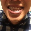 제니스라인치과교정과치과의원 네이버블로그