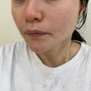 부평일번가 | 인천 부평피부관리 데자뷰메디스킨 인천점 아쿠아필 피지 제거 후기