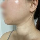 이수역(7) | 이수역피부과 티타늄리프팅 후기 | 시술당일 ~ 7일차