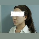 여의도 피부과 : 모공 레이저 / 모공 주사 후기 : 아토스 레이저