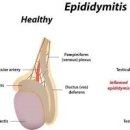 고환염 부고환염 증상 원인 통증 치료 소아 고환염전 주의~ 이미지