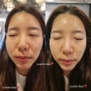 더맨즈룸 | 인천 :: 부평피부관리 "키웰" 에서 샤이니 펌킨관리로 저자극 각질정돈
