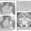 C7 radiculopathy, 장흉신경마비로 인한 winging scapular에 대하여 이미지