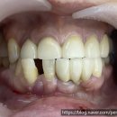 7월7일 치과의원 | 서구청 치과 7월7일치과 아래 앞니 임플란트