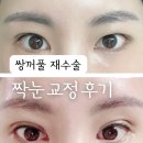 호박안경 | 짝눈교정, 강남성형외과 쌍꺼풀 재수술 쌍꺼풀후기 : 쌍수재수술 붓기 통증 라인