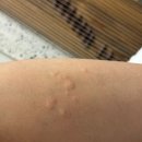 강가 선릉점 | 다리 발진 가려움 원인 흡혈파리 샌드플라이 물린 자국 치료 후기