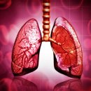 폐가 굳는 ‘이 질환’…10명 중 6명은 5년 안에 사망? 이미지