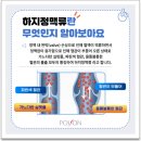 하지정맥류역류, 어떻게 알 수 있을까? 이미지