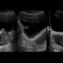 MRI Findings of Inverted Urothelial Papilloma of the Bladder 이미지